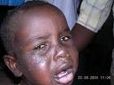 Vitamin B3 deficiency