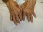 <b>Rheumatoid arthritis</b> is an