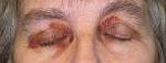 Primary, systemic amyloidosis and the dermatologist: Where classic ...