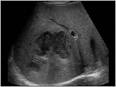 <b>Amebic liver abscess</b> with an