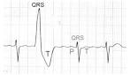 <b>Extrasystole Ventriculaire</b>