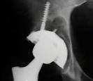 of acetabular <b>osteolysis</b>
