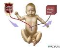 Exchange transfusion - series