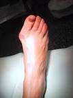 What is the treatment <b>hallux</b>