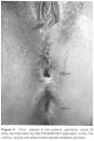 Sao Paulo Medical Journal - Transsphinctericanorectal ...