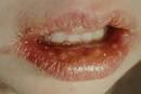 Oral Herpes (HSV-1) Pictures | STD Information