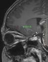 N�vrite optique r�tro bulbaire