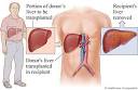 Liver transplant: A comparison between India, U.S. and Canada ...