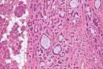 File:<b>Adenoid cystic carcinoma</b>