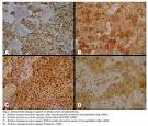 <b>myoepithelioma</b> from palate