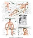 Vitamin B1 Deficiency: <b>Beriberi</b> - Netter Medical Artwork