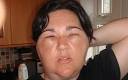 massive allergic reaction