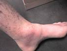 So <b>vasculitis</b> must mean