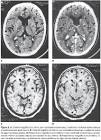 de <b>neurocisticercose</b>,