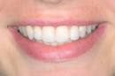 Straight teeth without unsightly braces - a new era in short-term ... 