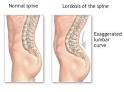 treated <b>Lordosis</b> has been