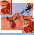 Endoscopic Sinus Surgery For Maxillary Sinus Mucoceles