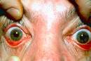 Inflamed bulbar conjunctivae secondary to rosacea