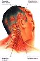 Treatments for Tension-related Headaches With Outer Banks Chiropractor