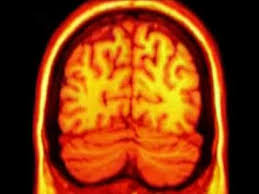 Indemnización de un millón de euros por diagnosticar un ictus y no tratarlo