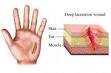 Cuts and Scrapes on skin