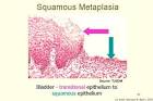 Squamous <b>Metaplasia</b>