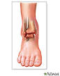 Ankle Injuries and Disorders: MedlinePlus