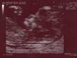BabyInc - Pregnancy and Baby scans - dating, nuchal, 20 weeks scan