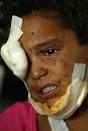 Rasha Muhamed Jazem, 7, who lost her eye and was injured by an unexploded ... - pict516