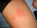bed bug bites pictures, bedbug bites: what do they look like ...