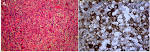 hormone <b>pituitary adenoma</b>