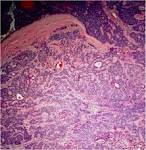<b>adenoid cystic carcinoma</b>