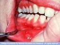 How To Cure Canker Sores Fast?