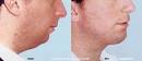 Facial Liposuction, Washington, Plastic Surgery, Steven Blair Hopping, MD, ... - facial_liposuction1