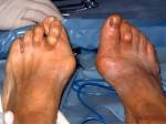 <b>Hallux</b> valgus und Hammerzehe
