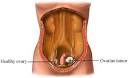 <b>Ovarian Neoplasm</b> Symptoms