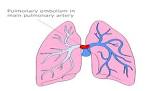 Changing definitions for massive <b>pulmonary embolism</b> | Dr.S