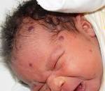 Blueberry muffin baby: A pictoral differential diagnosis