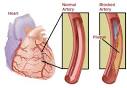 Health Problem &amp; Solutions: Angina Pectoris