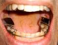 Bruxism: Advice, Links, Resources