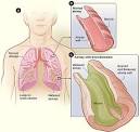 What Is Bronchiectasis? - NHLBI, NIH