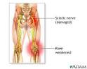 Sciatic nerve damage: MedlinePlus Medical Encyclopedia Image