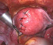 Uterine fibroid - Wikipedia, the free encyclopedia