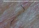 MORGELLONS DISEASE Awareness - MORGELLONS DISEASE Awareness