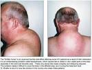 The Dr. Mueller Solution for "Buffalo Hump" using VASER ...