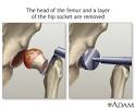 Hip joint replacement - series: MedlinePlus Medical Encyclopedia