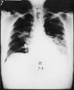 legionnaires' disease 192 - RightDiagnosis.