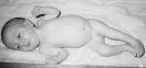 TRISOMY 18