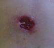 Abscess - Wikipedia, the free encyclopedia