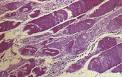 6)in acute <b>rhabdomyolysis</b>